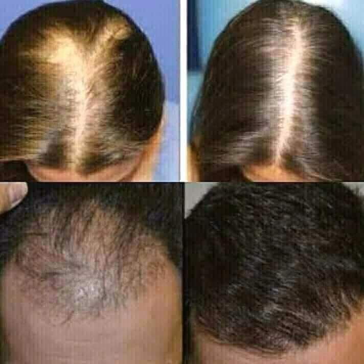الحل النهائي لتساقط الشعر